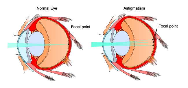 Astigmatism