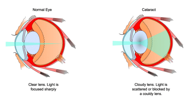 Normal eye vs Eye with Cataracts Cataracts