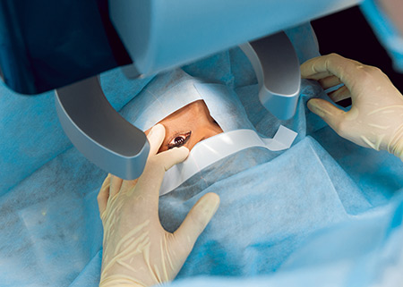 Cataract Surgery