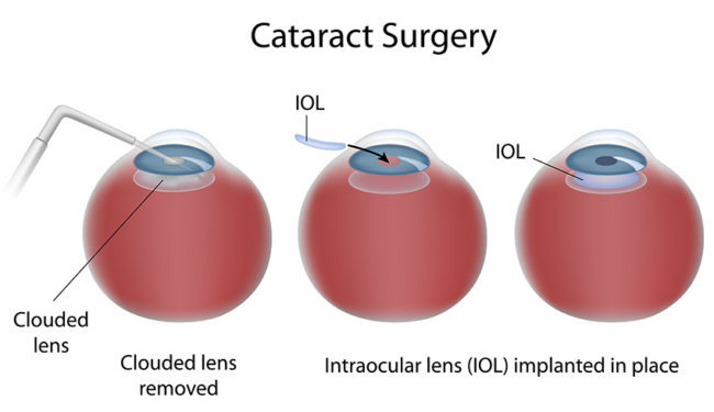 Cataract Surgery Chart Cataract Surgery
