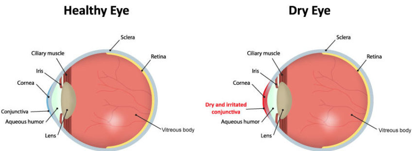 Dry eyes: Symptoms, causes and treatments