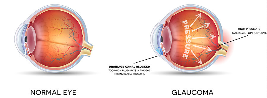 Glaucoma