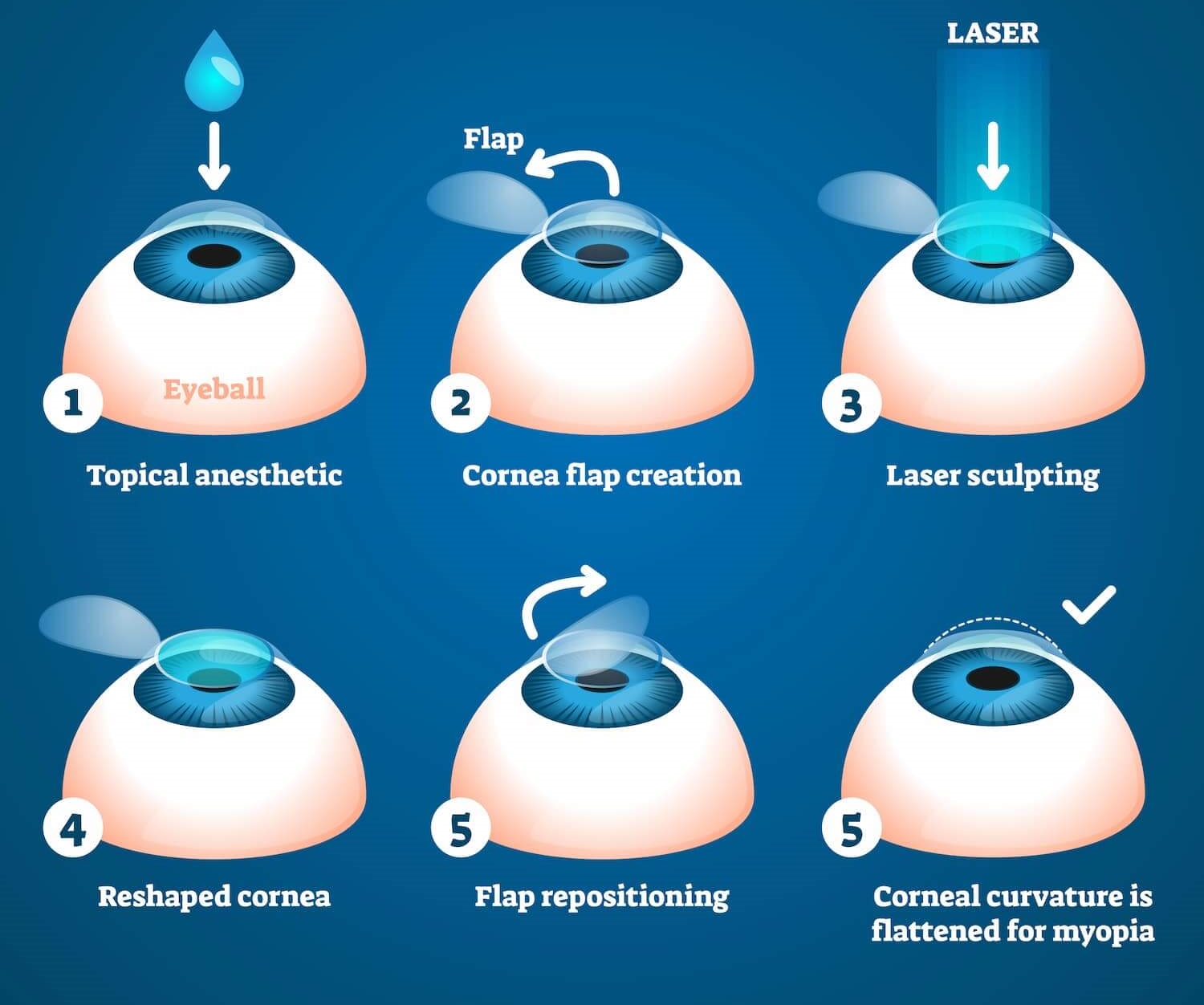 Prk lasik sales